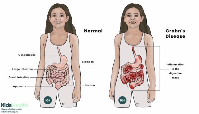 Illustration of child with normal gastrointestinal tract compared with Crohn's disease