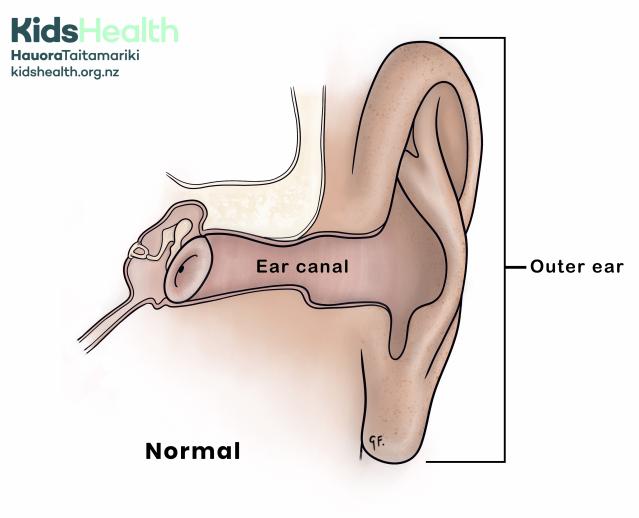 Illustration of a child's normal outer ear showing the outer ear and ear canal. The ear canal leads to the inside of the ear.