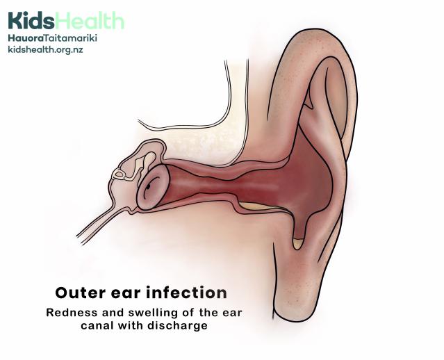 A side view illustration of a child's ear showing an outer ear infection. There is redness and swelling inside the ear canal, with discharge coming out of the ear.