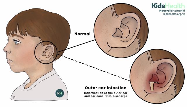 Illustration of a child showing the difference between a healthy ear and an infected outer ear. The infected outer ear looks red and has yellow fluid coming out.
