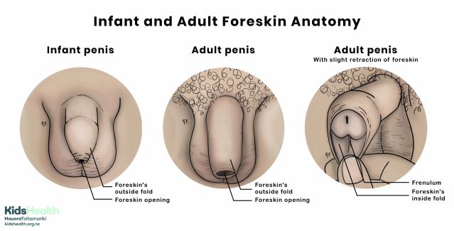Medical illustration showing an infant foreskin and adult foreskin with retraction of adult foreskin