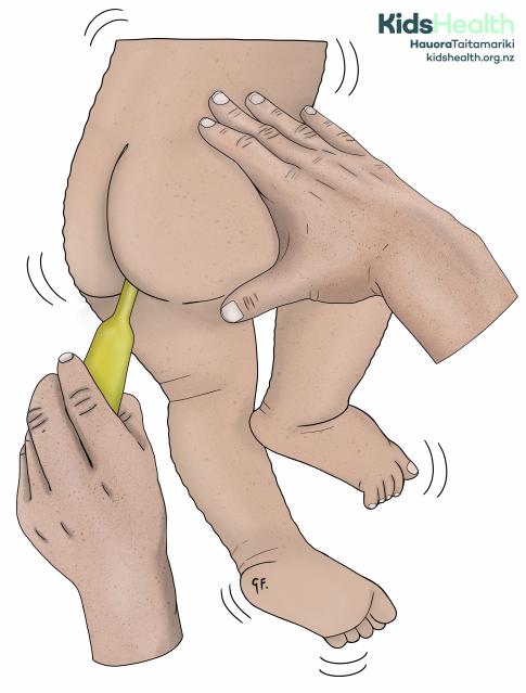 Illustration of parent giving a young child rectal diazepam for a seizure