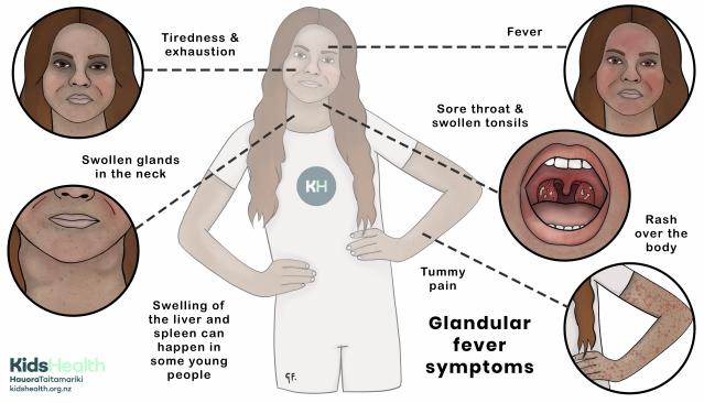 An illustration showing a teenager with the common symptoms of glandular fever