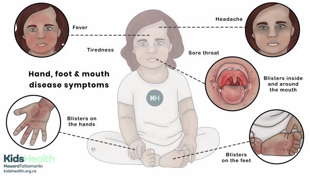 This illustration shows a child with symptoms of hand, foot, and mouth disease, including fever, headache, sore throat, tiredness, blisters on the hands and feet, and blisters inside and around the mouth. Each symptom is highlighted in close-up circles around the child for clarity.