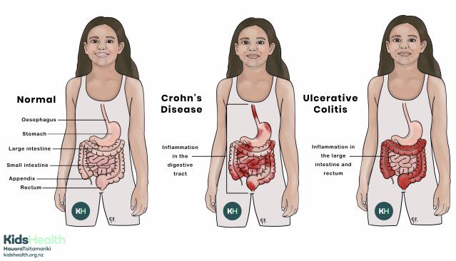 Image showing child with normal gastrointestinal tract compared with ulcerative colitis and Crohn's disease