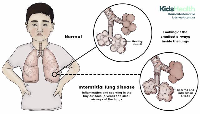 Illustration showing healthy lung air sacs compared with scarred and inflamed air sacs in interstitial lung disease in a child.