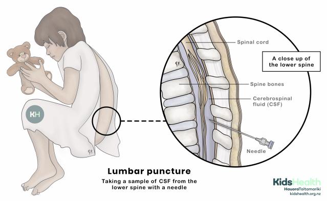 An illustration showing a child curled up holding a teddy, with a close-up of the lower spine showing where a lumbar puncture (spinal tap) is done using a needle to collect fluid.