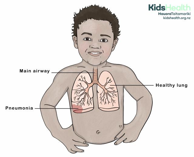 Illustration of a child with the lungs shown. One lung is labelled healthy, while the other shows pneumonia with an infected area in the lower part of the lung.