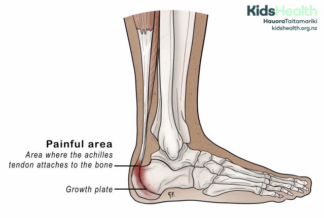 Diagram showing the painful area in the heel from Sever’s disease, where the Achilles tendon attaches to the bone.
