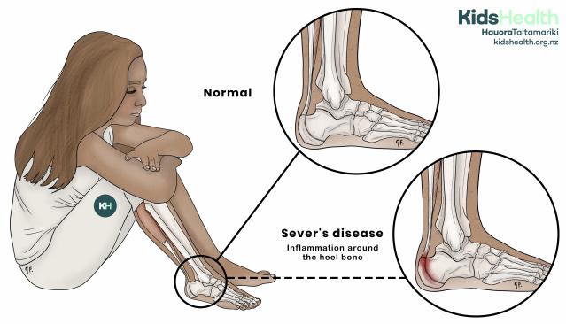 Illustration of a child with a zoomed-in view of Sever’s disease showing heel inflammation, compared with a normal heel.
