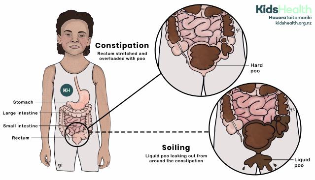 Illustration showing constipation with encopresis and soiling in a child