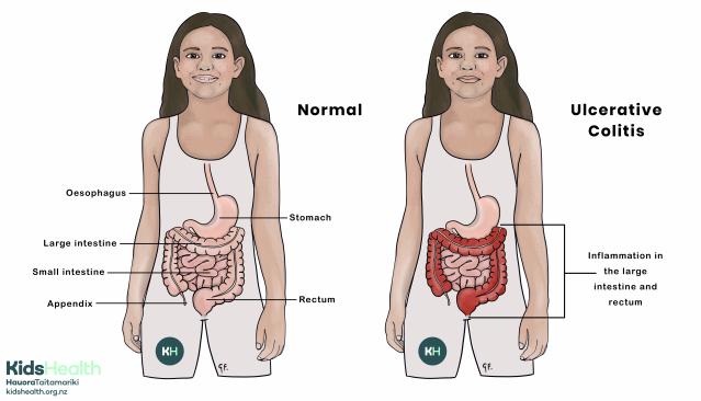 Illustration comparing a normal digestive system with ulcerative colitis, showing inflammation in the large intestine and rectum.