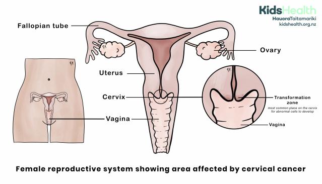 Illustration of the female reproductive system showing the uterus, cervix, vagina, fallopian tubes, and ovaries, with a close-up of the cervix highlighting the transformation zone where abnormal cells may develop.