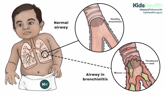 Illustration of a child showing the lungs, with close-up diagrams comparing a normal airway and bronchiolitis. The bronchiolitis diagram shows thickened airway walls and mucus blocking the airway.