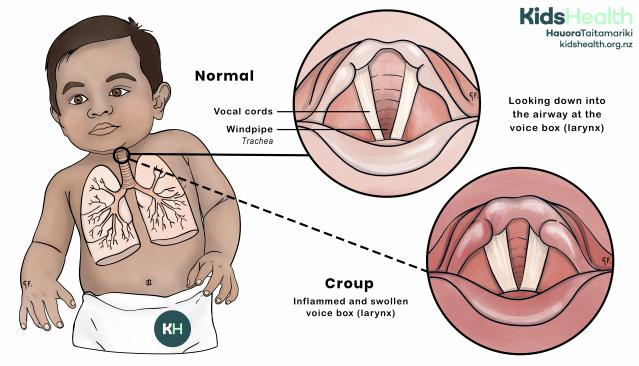 Illustration of a child showing the lungs and airway, with close-up diagrams comparing a normal voice box (larynx) and croup. The croup diagram shows swelling and inflammation around the vocal cords.