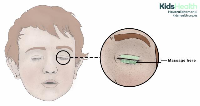 Illustration of a child with eyes closed, showing where to massage the eyelid for a stye. A close-up circle highlights the upper eyelid with the area to massage shaded in green.