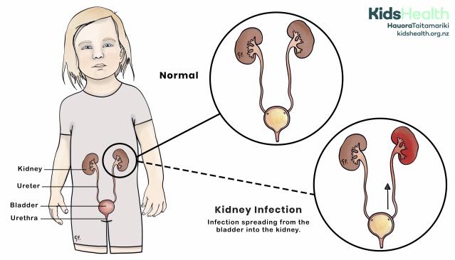 Illustration of a young child with the urinary system labeled, showing the kidneys, ureters, bladder, and urethra. Enlarged views depict a normal urinary system and a kidney infection where the infection spreads from the bladder to the kidney, with one kidney highlighted in red to indicate inflammation.