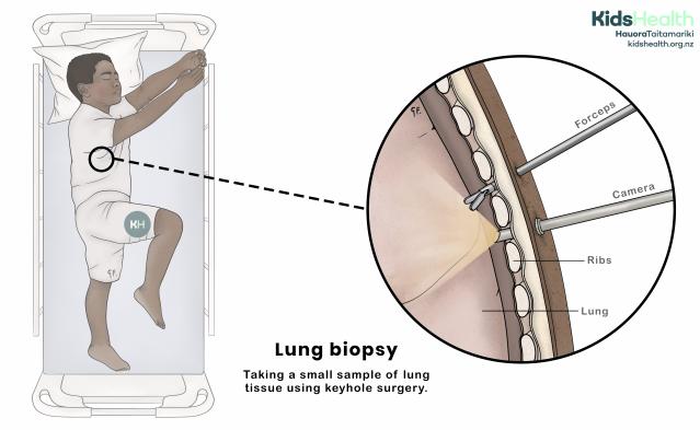 A child lying on their side in a hospital bed with arms raised above their head, prepared for a lung biopsy. An enlarged cross-section shows forceps and a camera inserted between the ribs to take a small lung tissue sample using keyhole surgery.