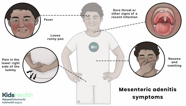 Illustration showing symptoms of mesenteric adenitis, including tummy pain, fever, nausea, vomiting, sore throat, and loose poo.