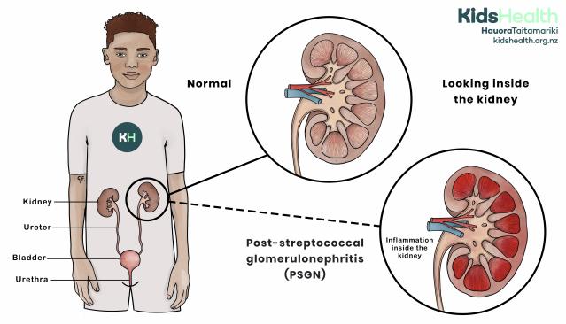 Illustration of a boy showing the urinary tract and a comparison of normal kidney structure versus a kidney with inflammation from post-streptococcal glomerulonephritis (PSGN).