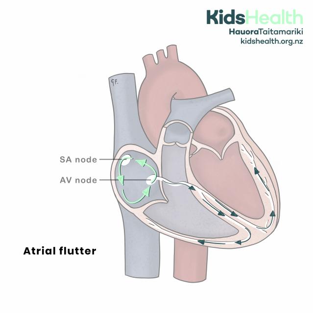 Cross-section of the heart showing atrial flutter, with abnormal electrical signals looping rapidly around the right atrium before travelling to the AV node and ventricles.
