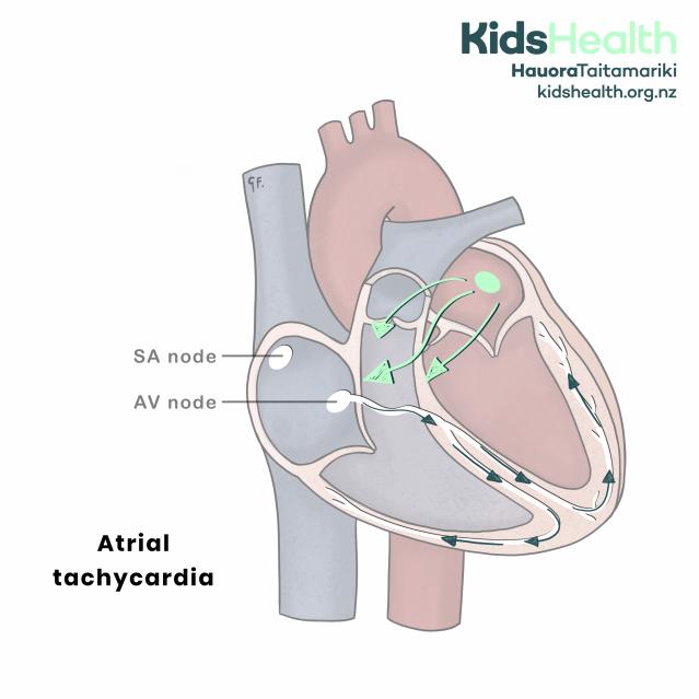 Cross-section of the heart showing atrial tachycardia, with abnormal electrical signals starting in the atrium instead of the SA node and travelling to the AV node and ventricles.