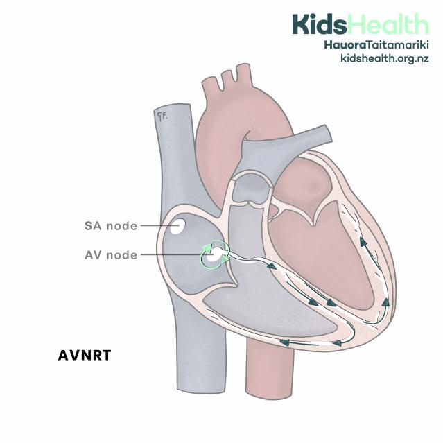 Cross-section of the heart showing atrioventricular nodal reentrant tachycardia (AVNRT), with abnormal electrical signals looping within and around the AV node before travelling to the ventricles.