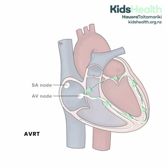 Cross-section of the heart showing atrioventricular reentrant tachycardia (AVRT), with abnormal electrical signals looping between the atria and ventricles through an extra pathway.