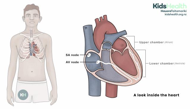 Illustration of a person showing the location of the heart inside the chest, with a detailed cross-section of the heart highlighting the SA node, AV node, upper chambers (atria), and lower chambers (ventricles).