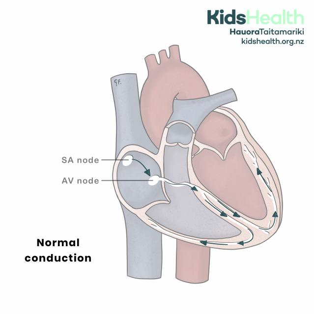 Cross-section of the heart showing normal electrical conduction, with arrows tracing the pathway from the SA node to the AV node and through the ventricles.