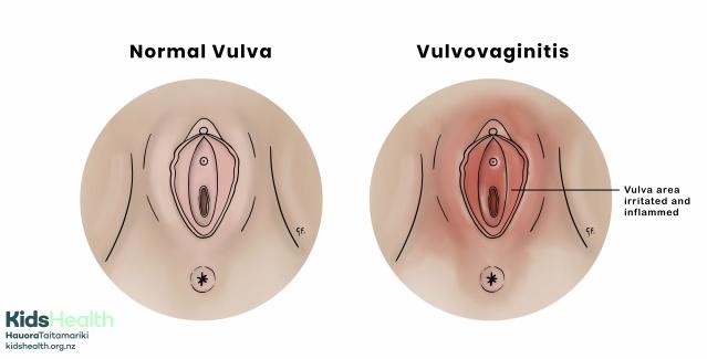 Two anatomical medical illustrations of the vulva, one showing normal anatomy and one showing vulvovaginitis with irritation and inflammation.