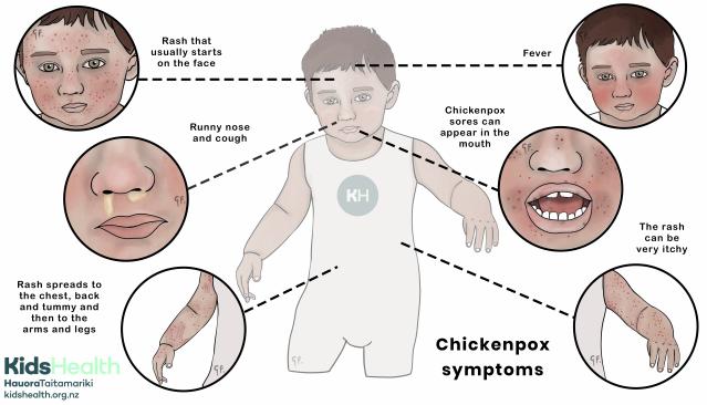 Illustration showing common symptoms of chickenpox in children, including rash on the face and body, itchy rash, fever, runny nose and cough, and sores inside the mouth.