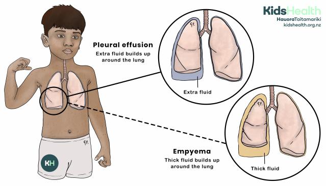 Illustration of a child showing pleural effusion, where extra fluid builds up around the lung, and empyema, where thick fluid collects around the lung.
