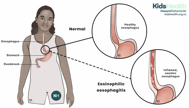 Illustration of a child showing the digestive system, with close-up diagrams comparing a normal oesophagus and eosinophilic oesophagitis. The eosinophilic oesophagitis diagram shows an inflamed, swollen oesophagus.