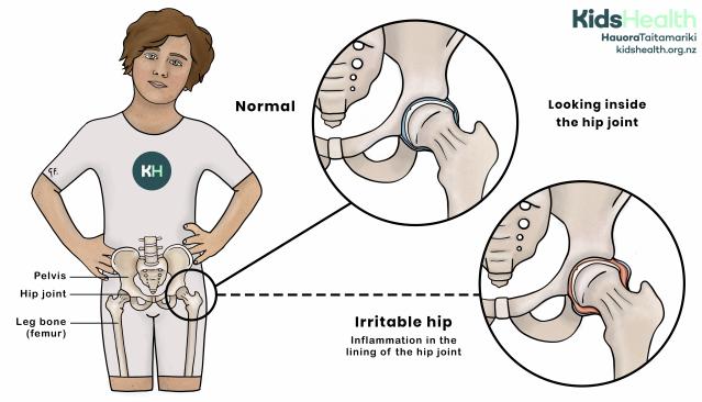 Illustration comparing a normal hip joint and an irritable hip. The normal joint shows smooth alignment of the pelvis and femur. The irritable hip shows inflammation in the lining of the joint.