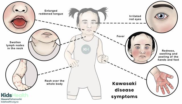Illustration showing the symptoms of Kawasaki disease in a child, including red eyes, fever, swollen lymph nodes, rash, red tongue, and redness or swelling of the hands and feet.