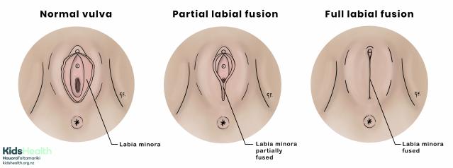 Three medical illustrations of the vulva showing normal anatomy, partial labial fusion, and full labial fusion.