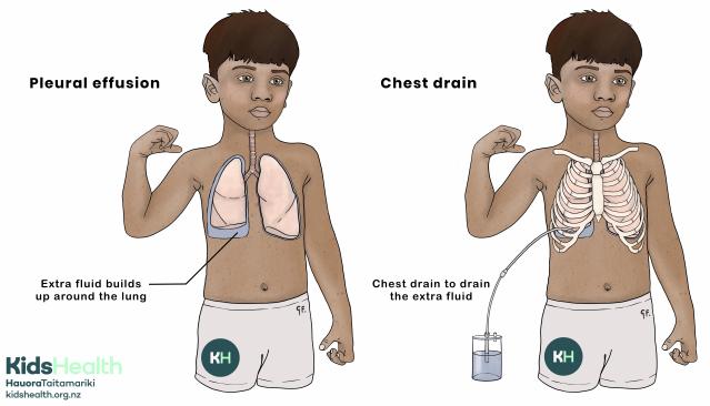 Illustration of a child showing pleural effusion with extra fluid around the lung, compared to treatment with a chest drain that removes the fluid.