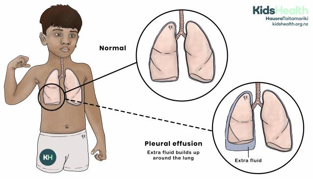 Illustration of a child’s lungs showing normal lungs compared with pleural effusion, where extra fluid builds up around one lung.