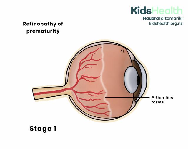 An illustration showing stage 1 retinopathy of prematurity, where a thin line forms between the normal and underdeveloped areas of the retina at the back of the eye.