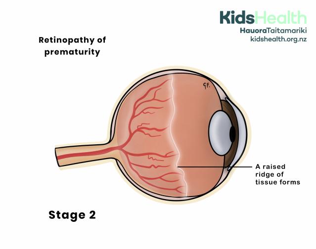 An illustration showing stage 2 retinopathy of prematurity, where a raised ridge of tissue has formed between the normal and underdeveloped areas of the retina at the back of the eye.