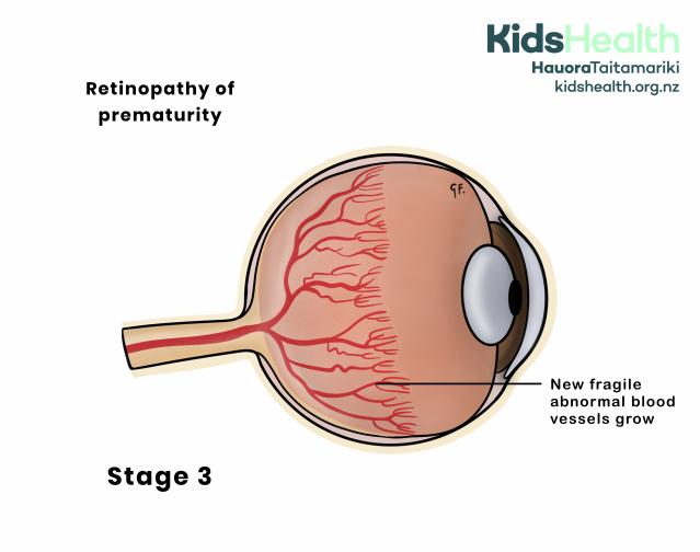An illustration showing retinopathy of prematurity stage 3, where Fragile new abnormal red blood vessels are growing and multiplying towards the centre of the eye.