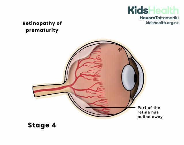 Illustration of an eye showing retinopathy of prematurity stage 4.  The retina has slightly detached. 