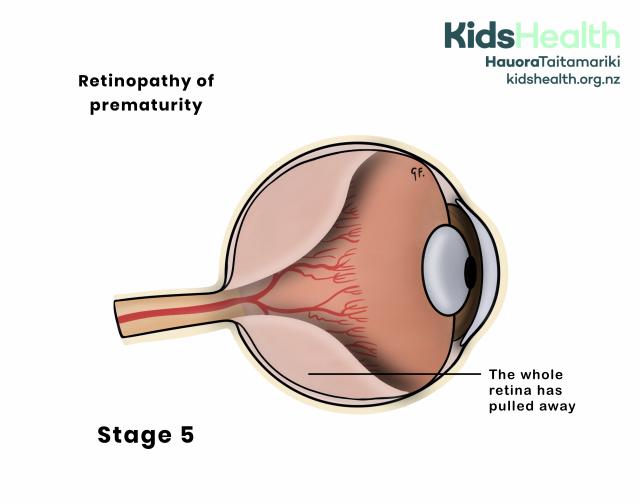 Illustration of an eye showing retinopathy of prematurity stage 5. The retina has completely detached.