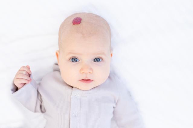 A baby lying on a white blanket with a small red strawberry birthmark (infantile haemangioma) on the top of their head.