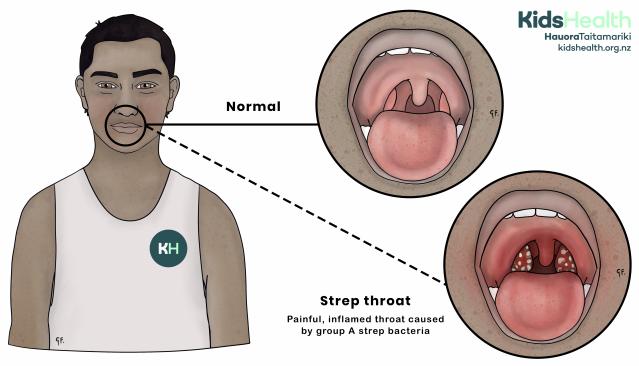 Illustration comparing a normal throat and a throat with strep throat. The normal throat looks pink and smooth. The throat with strep throat looks red, swollen, and has white patches on the tonsils. 