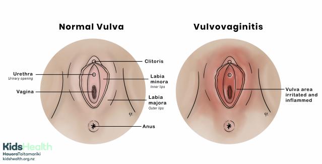 Two medical anatomical illustrations of the vulva, one showing normal anatomy and one showing vulvovaginitis with irritation and inflammation.