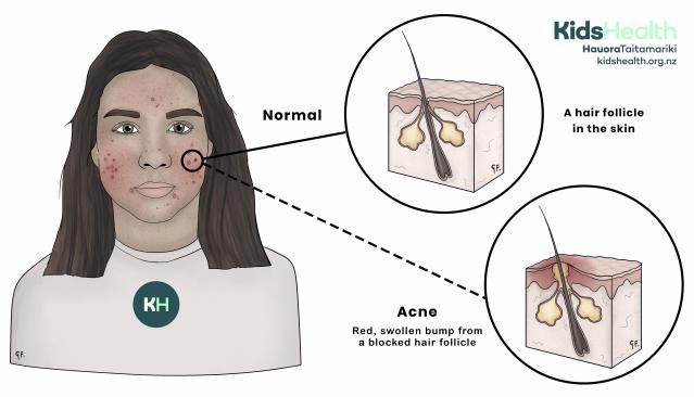 An illustration of a young person with acne on their face. A circle highlights the cheek and shows two close-up cross-sections of the skin. The first is a normal hair follicle. The second shows acne, with a blocked follicle and redness around it.