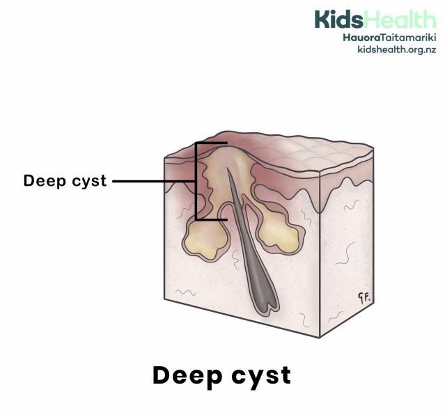 An illustration of a deep cyst under the skin. The cross-section shows a hair follicle with a large blocked sac filled with yellow pus deep beneath the skin’s surface. A label points to the deep cyst.
