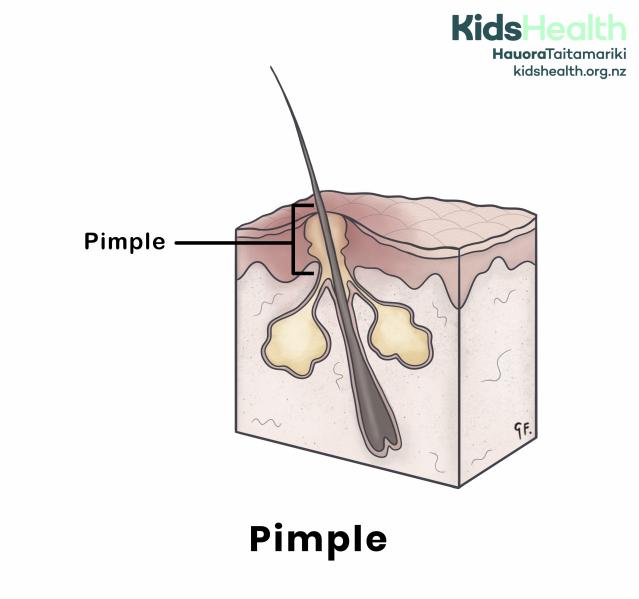 An illustration of a pimple under the skin. The cross-section shows a hair follicle with a blocked pore filled with yellow pus. A label points to the pimple.